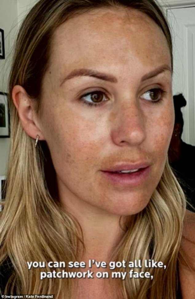 Kate Ferdinand corajosamente compartilhou suas lutas secretas contra a hiperpigmentação depois de compartilhar uma foto sem maquiagem no Instagram